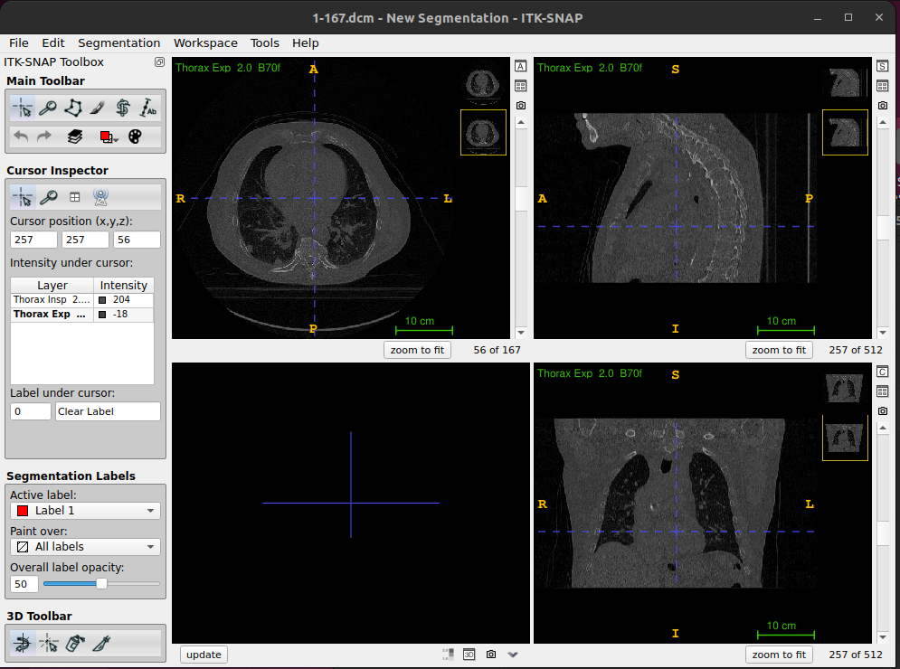 Figure. ITK-SNAP thumbnails, handlding two DICOM images (inhale_BH_CT and exhale_BH_CT for CT-PET-VI-02)