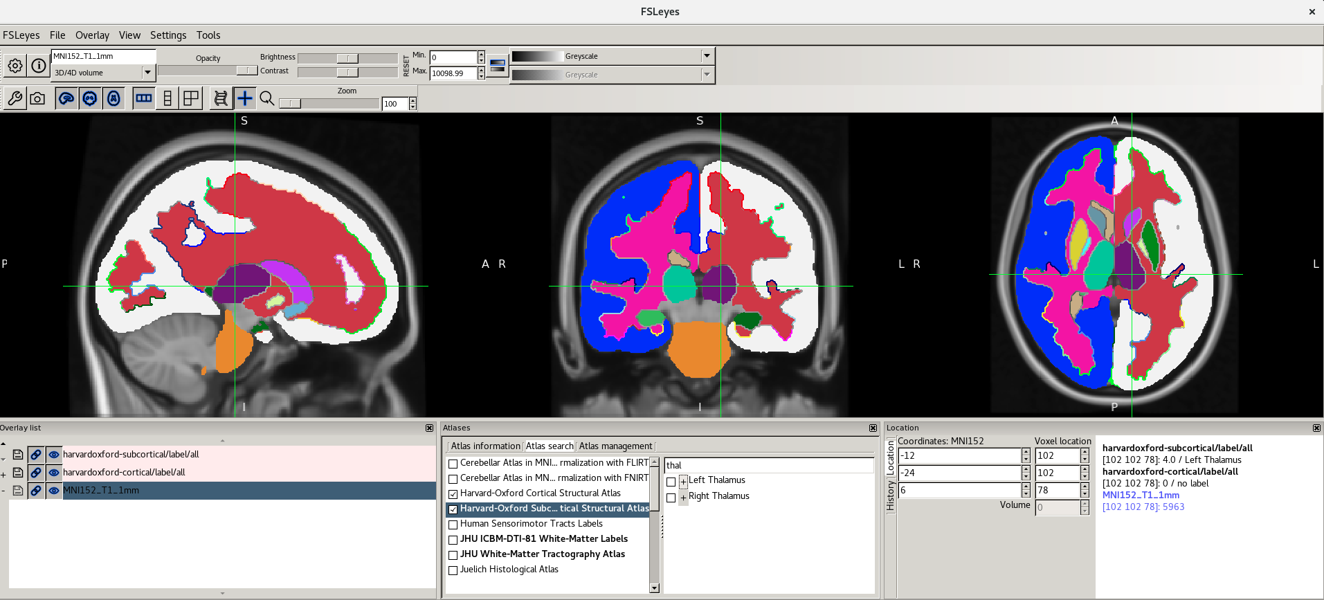 Left Thalamus