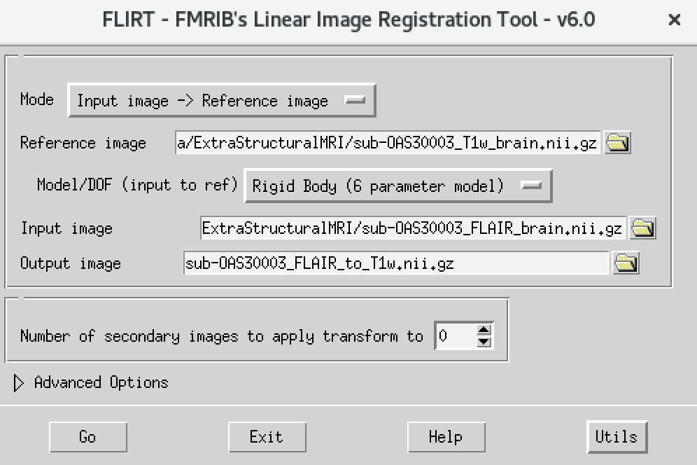 Coregistration of T1 and FLAIR