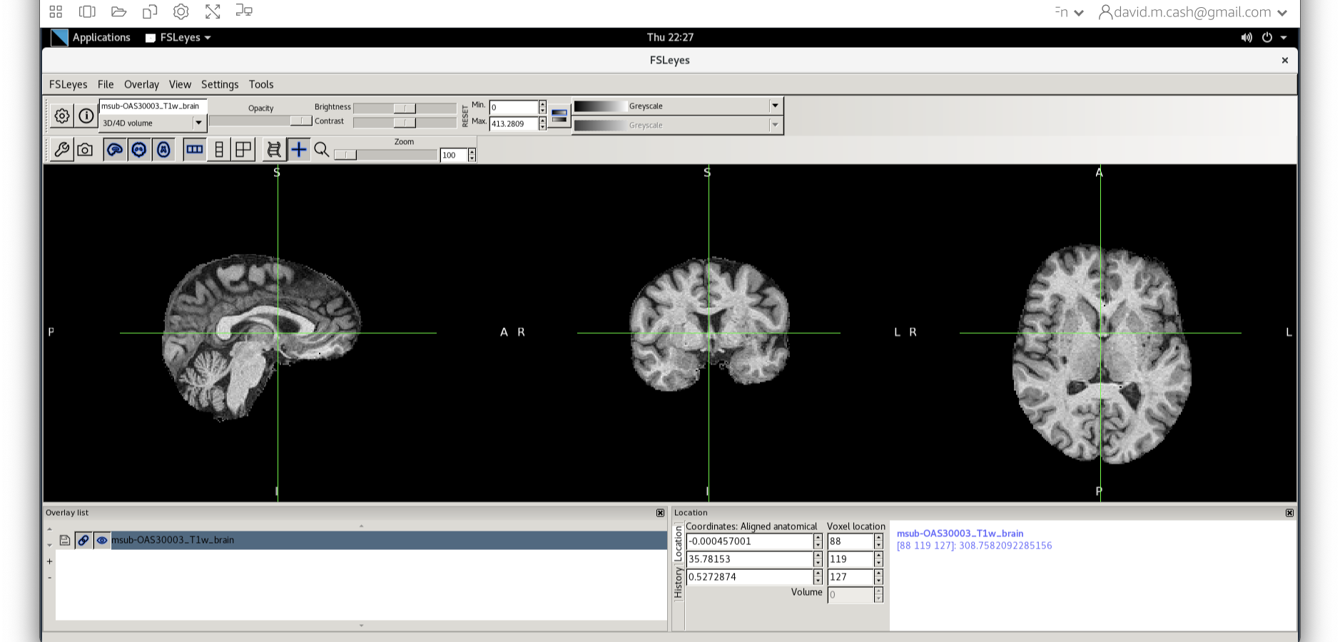 Skull stripped MRI