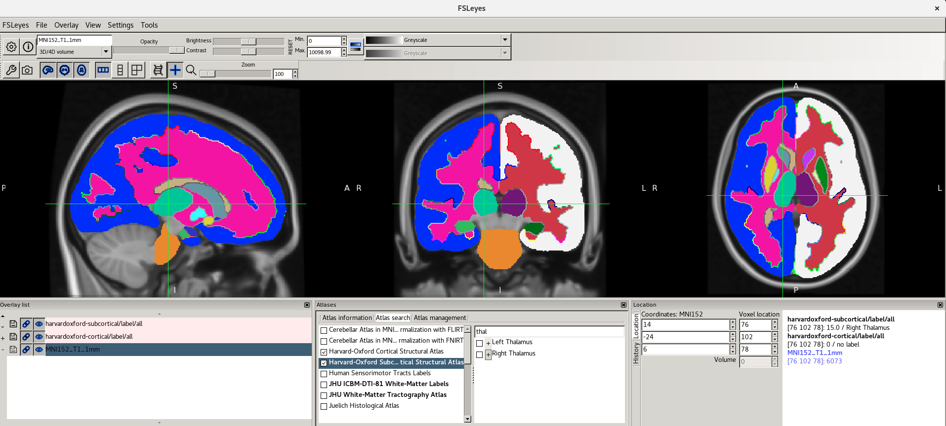 Right Thalamus